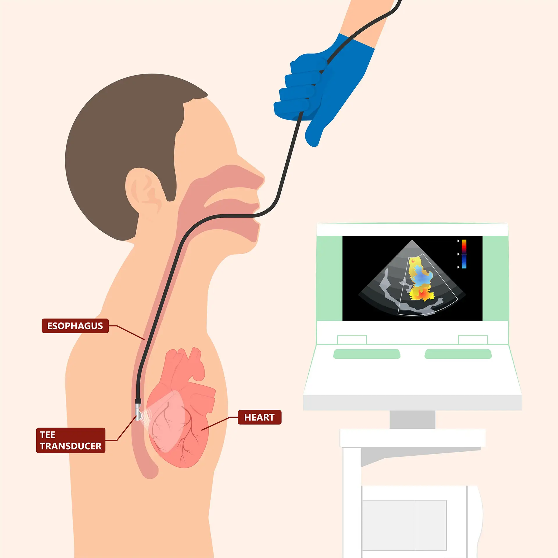 Ecocardiograma transesofágico