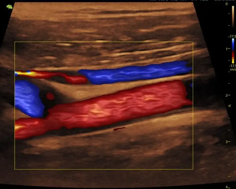 eco doppler carotidas